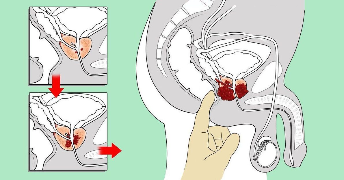 kā masēt prostatu